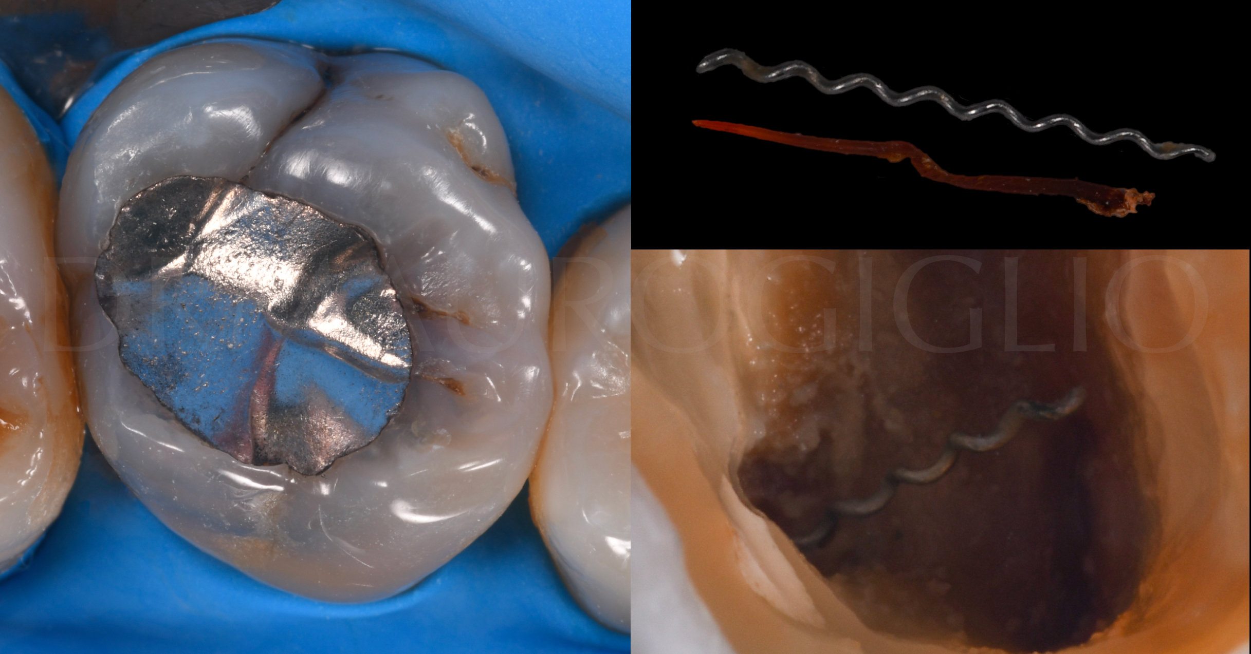 2 - Dr. Maglio Giglio - Visione elemento isolato con diga di gomma, della cavità, del lentulo e di un cono di guttaperca
