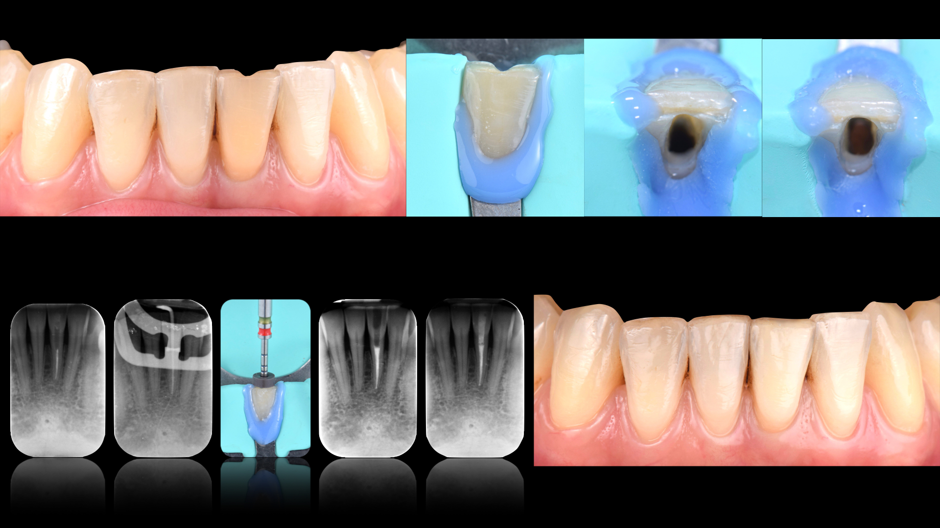 Caso clinico Dr. Pittaluga sulla terapia canalare del dente incisivo