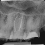 Trattamento endodontico di un ottavo superiore con quattro radici e quattro canali Dr. Natalini - fig. 2