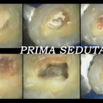 Trattamento endodontico di un ottavo superiore con quattro radici e quattro canali Dr. Natalini - fig. 3