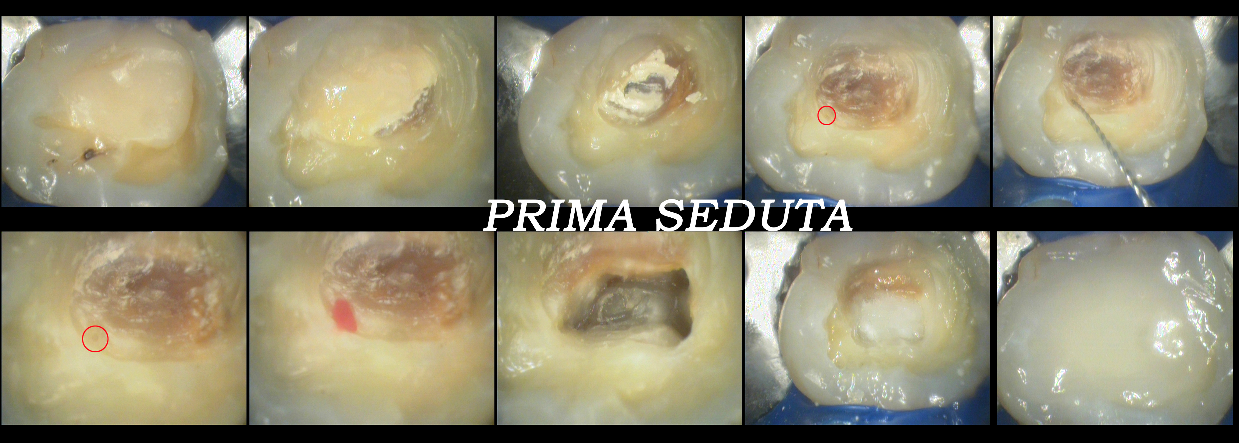 Trattamento endodontico di un ottavo superiore con quattro radici e quattro canali Dr. Natalini - fig. 3