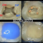 Trattamento endodontico di un ottavo superiore con quattro radici e quattro canali Dr. Natalini - fig. 4