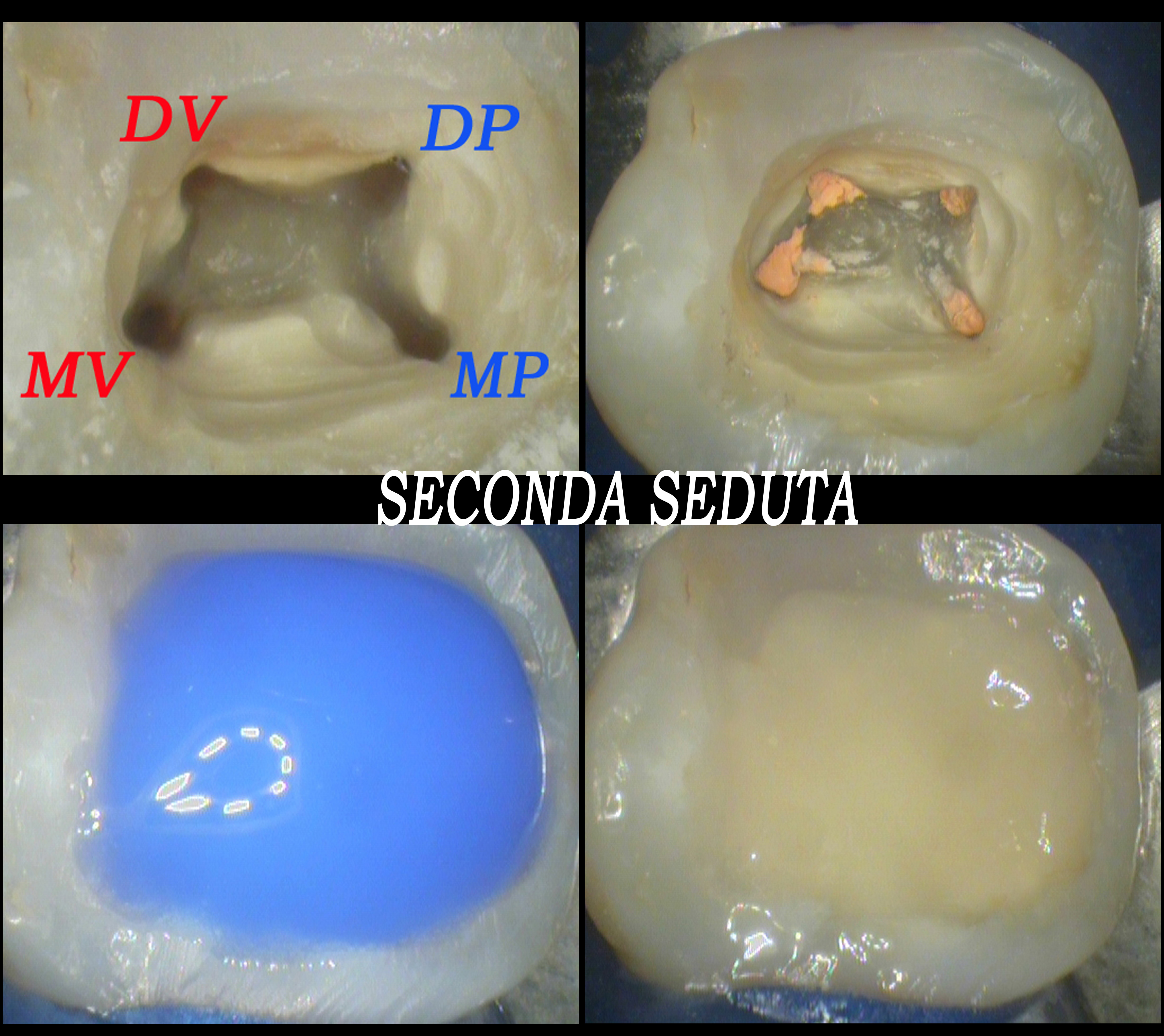 Trattamento endodontico di un ottavo superiore con quattro radici e quattro canali Dr. Natalini - fig. 4