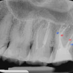 Trattamento endodontico di un ottavo superiore con quattro radici e quattro canali Dr. Natalini - fig. 5