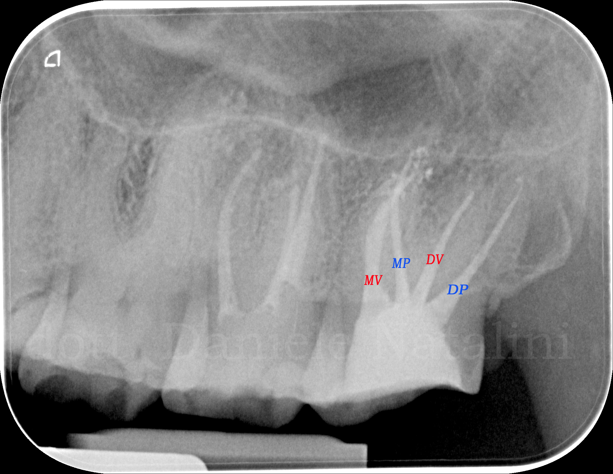 Trattamento endodontico di un ottavo superiore con quattro radici e quattro canali Dr. Natalini - fig. 6