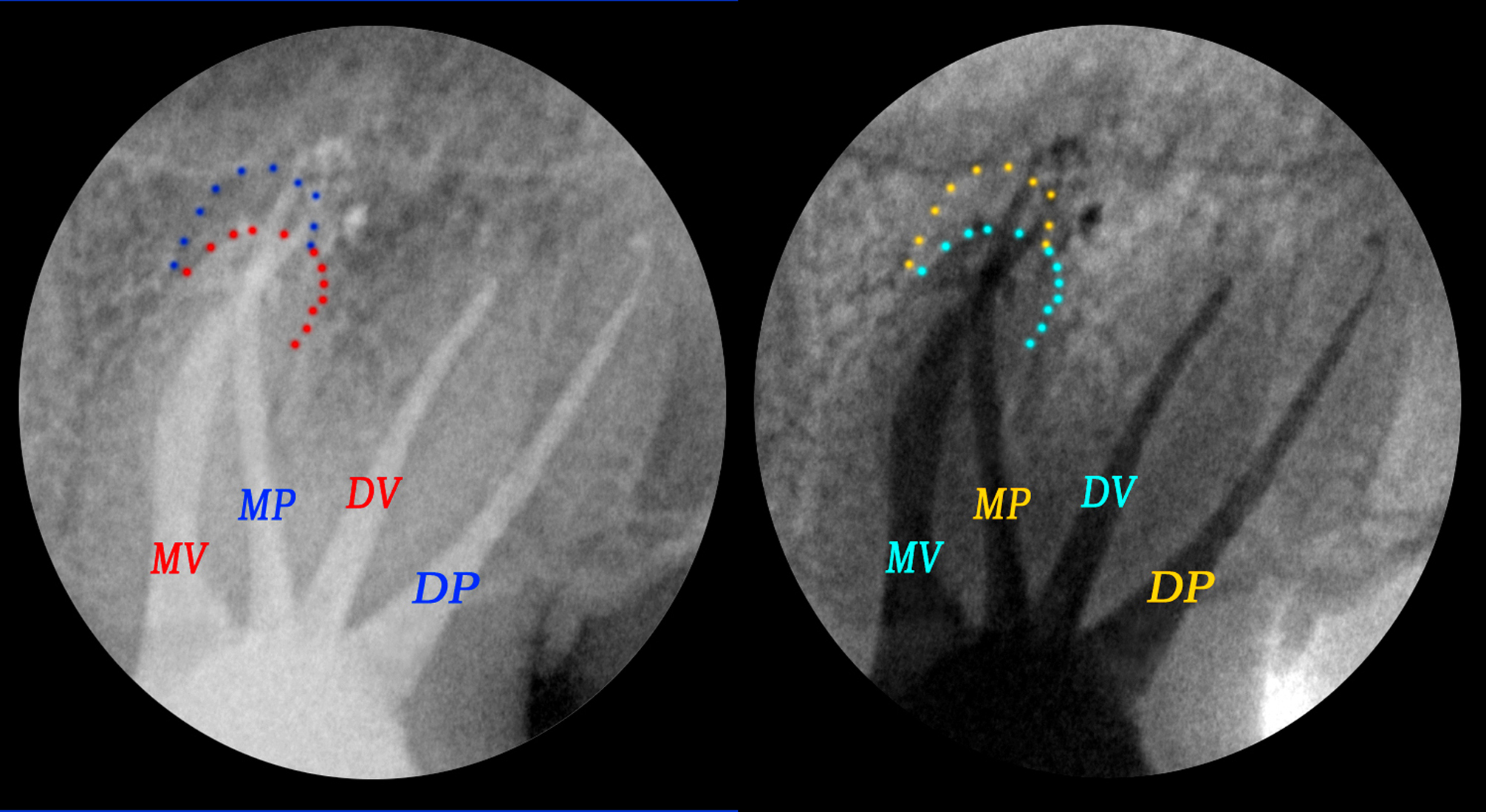 Trattamento endodontico di un ottavo superiore con quattro radici e quattro canali Dr. Natalini - fig. 7
